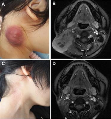 Is Immune Therapy Plus Chemotherapy More Effective Than Immune Therapy Alone for Unresectable Recurrent Nasopharyngeal Carcinoma?